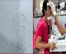 એક મહિલાની આંખમાંથી કાઢી 250 થી વધુ જૂ