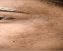 चेहऱ्यावर ठिपक्यांसारखे काळे डाग दिसतात, ही कारणे असू शकतात