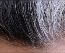 केस लवकर पांढरे होतात, या आजाराचा धोका असू शकतो