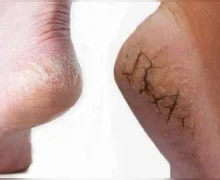 टाचांच्या भेगांचा त्रास दूर करण्यासाठी दररोज रात्री हे उपाय करा, पाय गुळगुळीत होतील