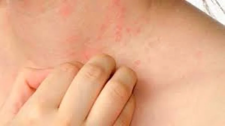 Measles: A deadly disease that can be prevented