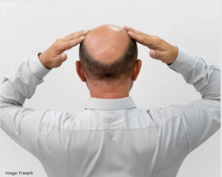 A ba(l)d rap: Is it worth reversing hair loss?