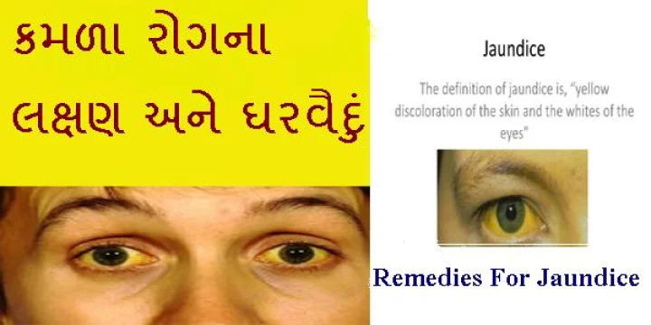 કમળા રોગના લક્ષણ અને ઘરગથ્થું ઉપાય