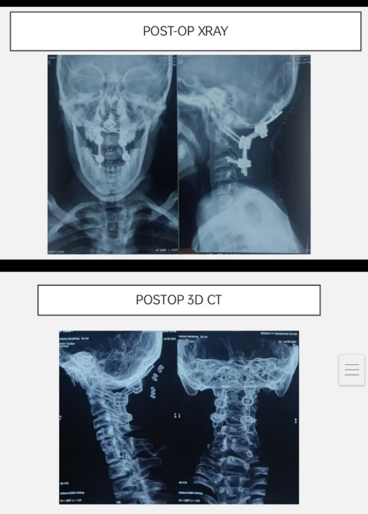 atlanto axial dislocation