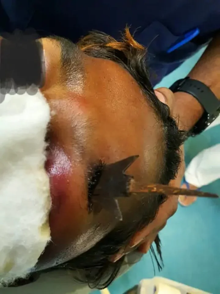  In Chhota Udepur, injured in an attack by a neighbor with a bow and arrow