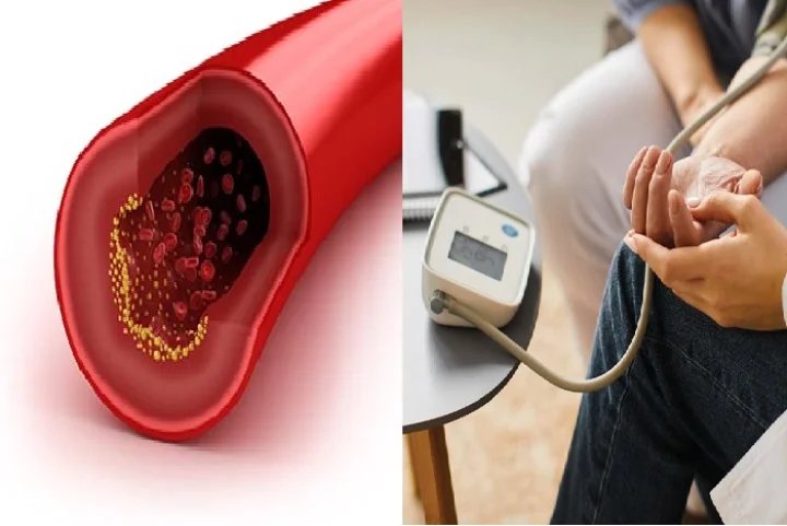 high bp and cholesterol