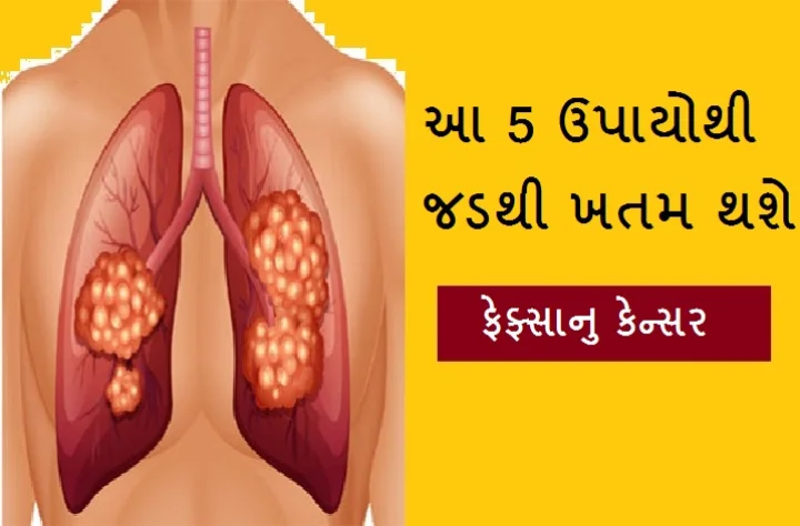 Lung Cancer