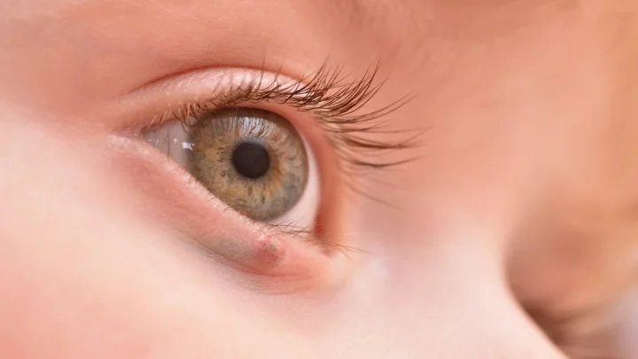 how does eye cancer develop