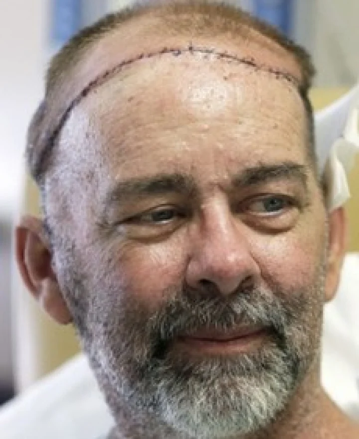 दुनिया का खोपड़ी और सिर की त्वचा का ट्रांसप्लांट