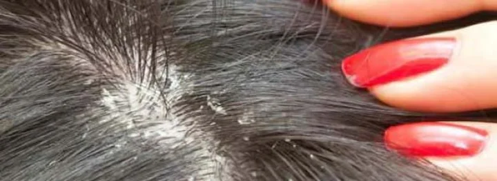 dandruff