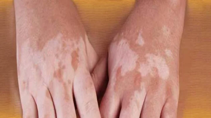 World Vitiligo Day