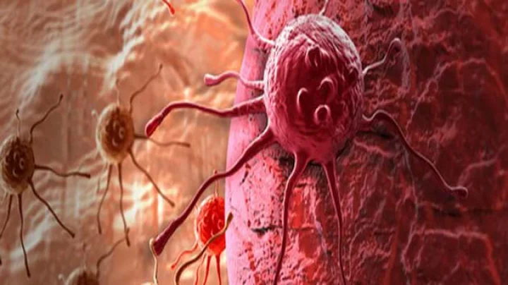 pancreatic cancer