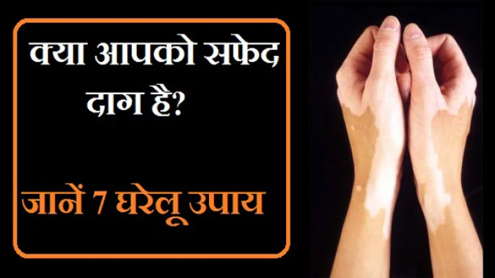 सफेद दाग