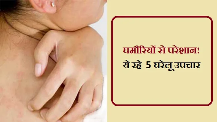 घमौरियां