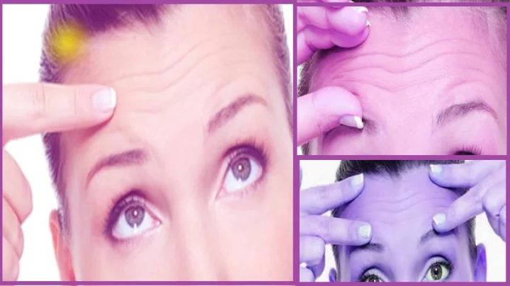 Forehead Lines