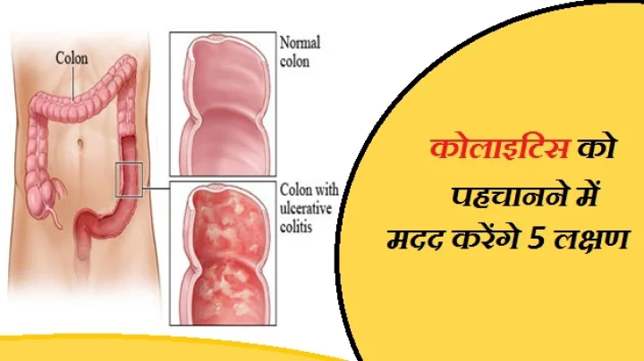 कोलाइटिस