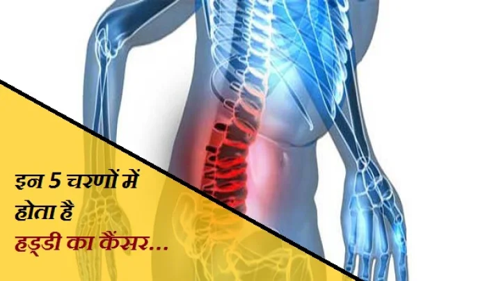 bone cancer