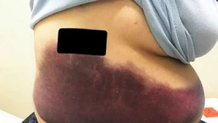 खांसी इतनी तेज आई कि पसली तक टूट गई