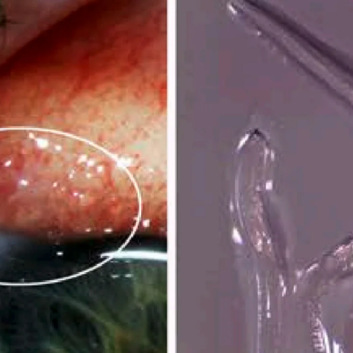 लहान मुलांच्या पोटात जंत का होतात? जंत निर्मूलन कसं करायचं? महत्त्वाची माहिती