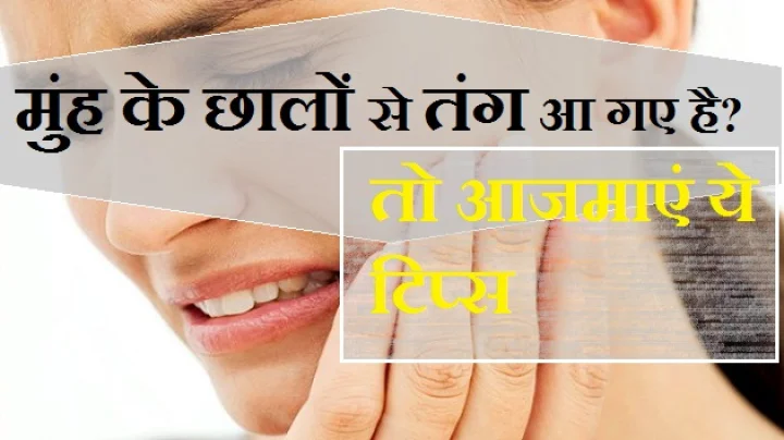मुंह में छाले