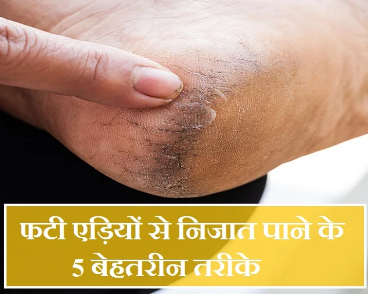 एड़ियां