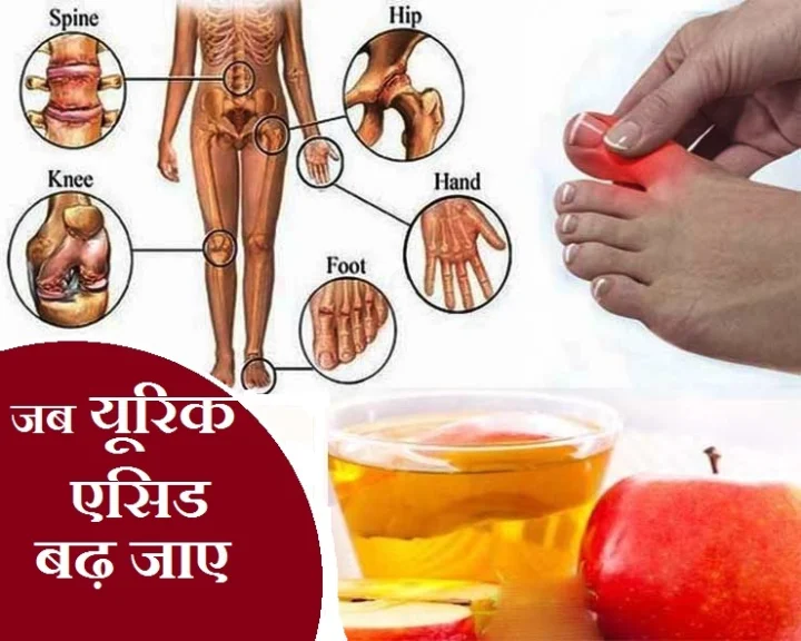 Uric Acid health problems