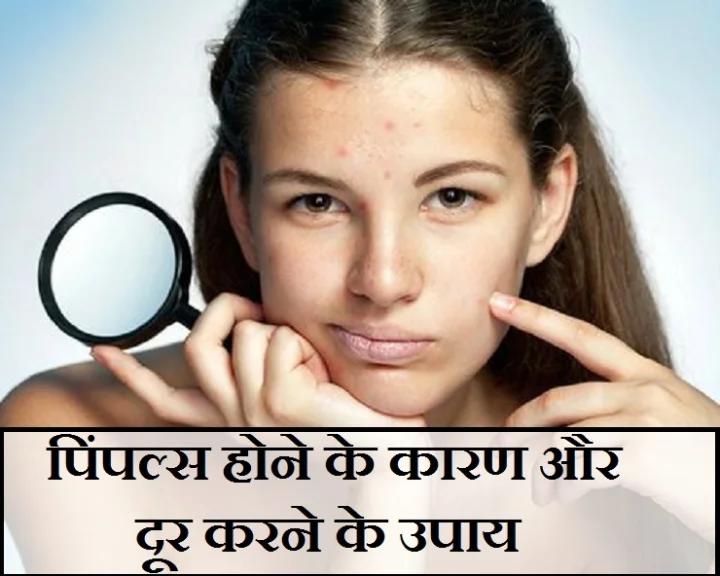 कील-मुंहासे