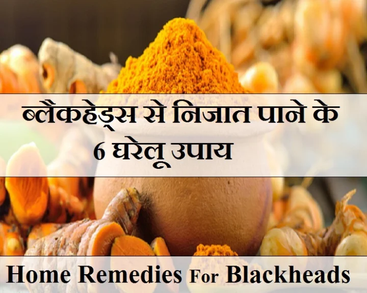 ब्लैक हेड्स से छुटकारा पाने के घरेलू उपाय
