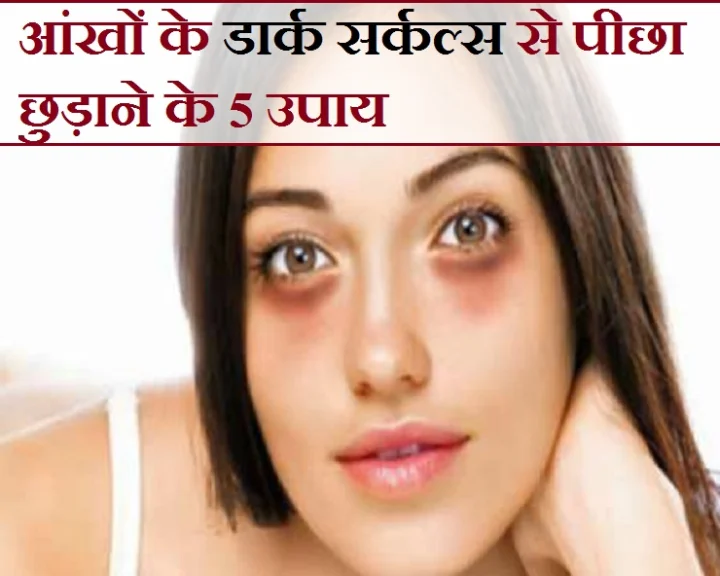 डार्क सर्कल्स हटाने के उपाय