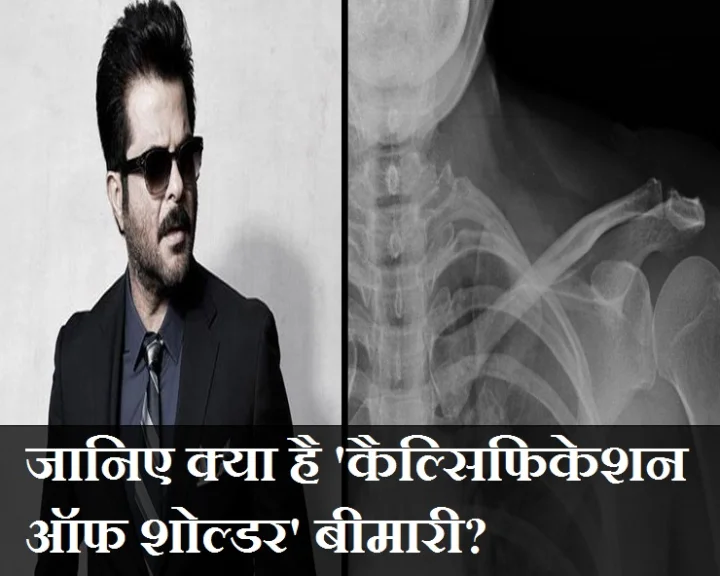 कैल्सिफिकेशन ऑफ शोल्डर