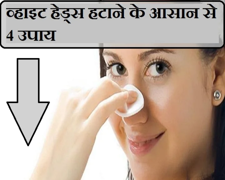 वाइट हेड्स हटाने के आसान से 4 उपाय