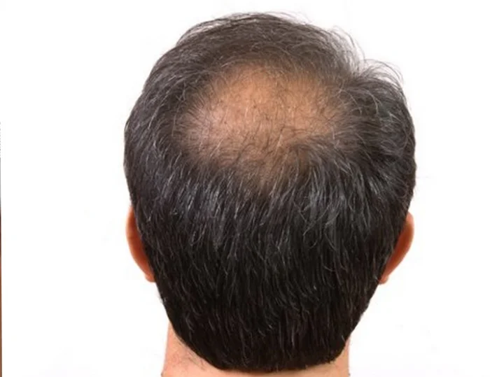 Manduki Mudra yoga Baldness