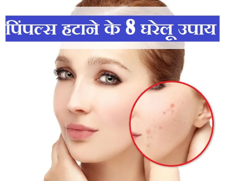 पिंपल्स