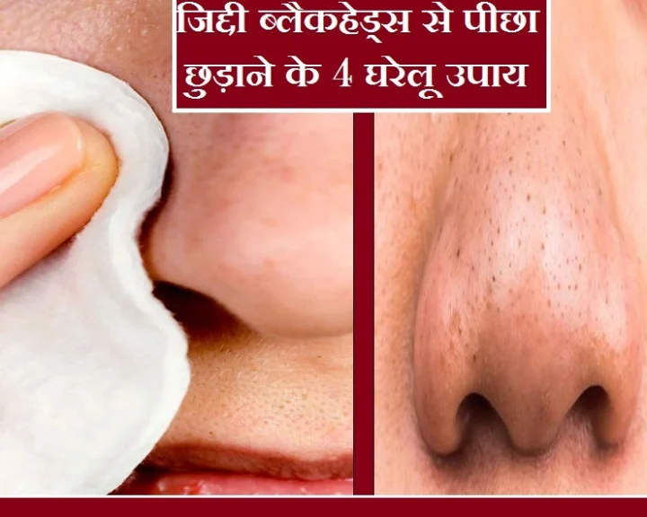 blackheads