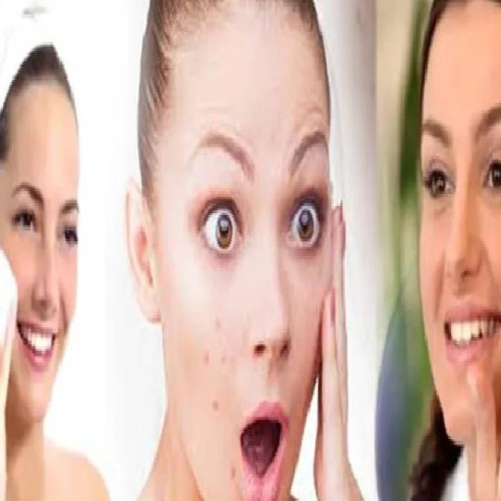 Rid of pimples problem पिंपल्सच्या समस्येपासून मुक्त होण्यासाठी या टिप्स फॉलो करा