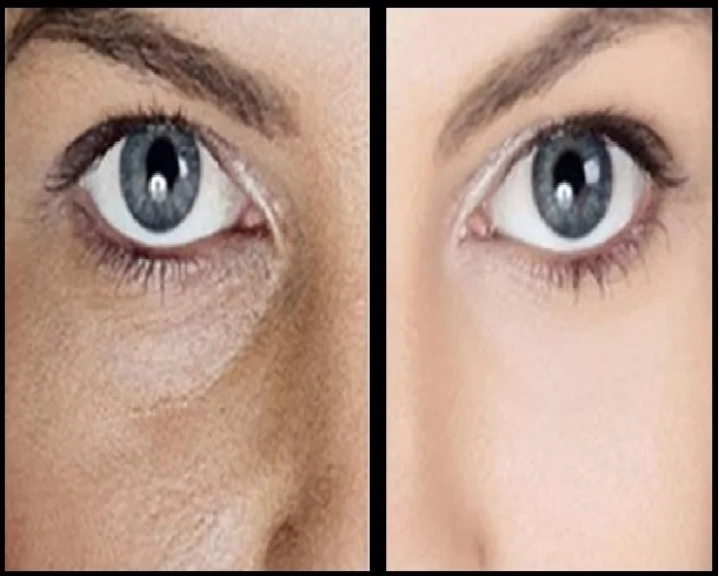 pores