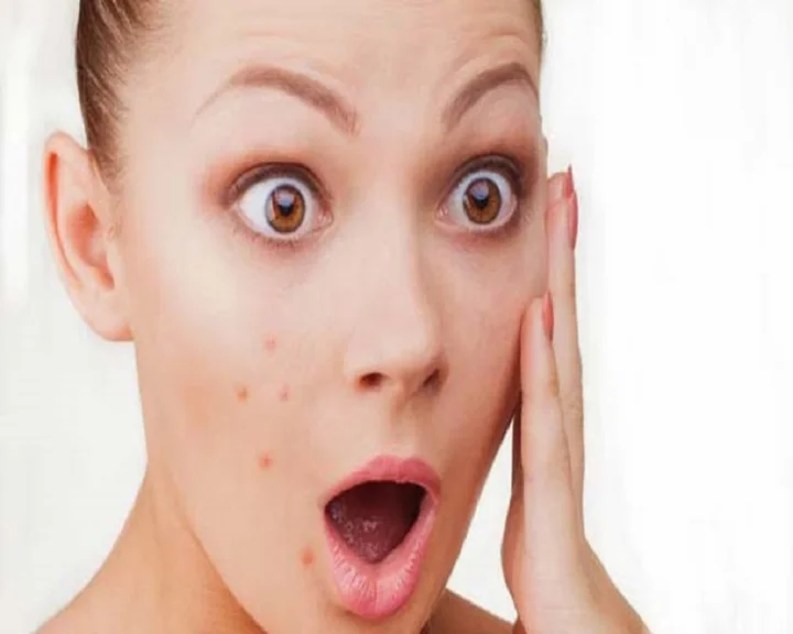 hormonal acne cure naturally