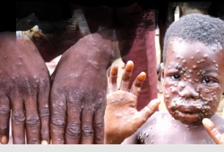 Monkeypox
