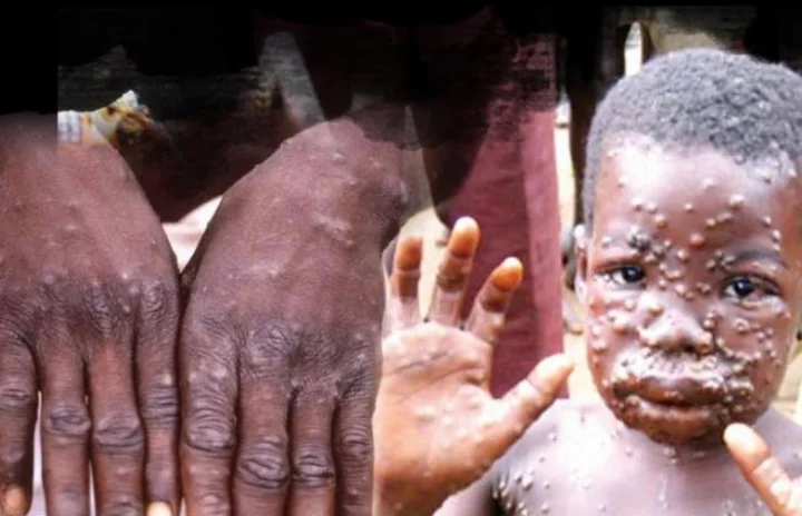 monkeypox
