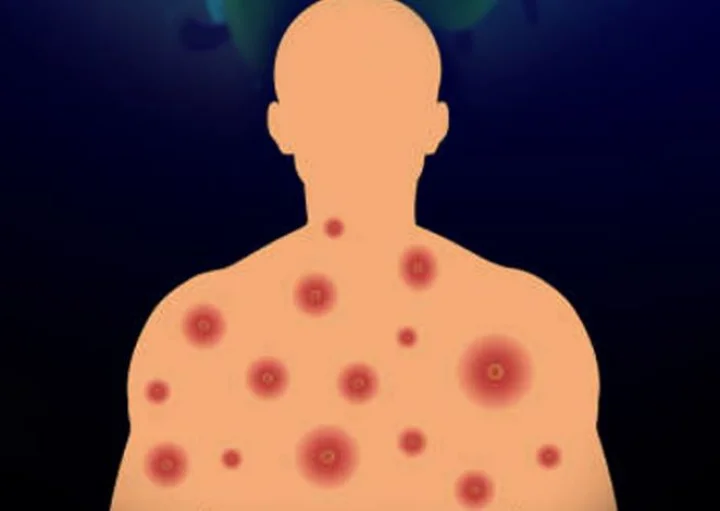 monkeypox