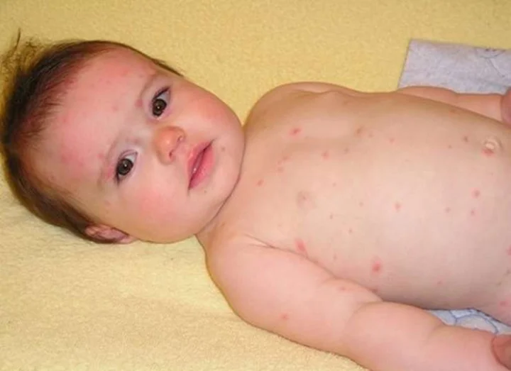 Measles in children