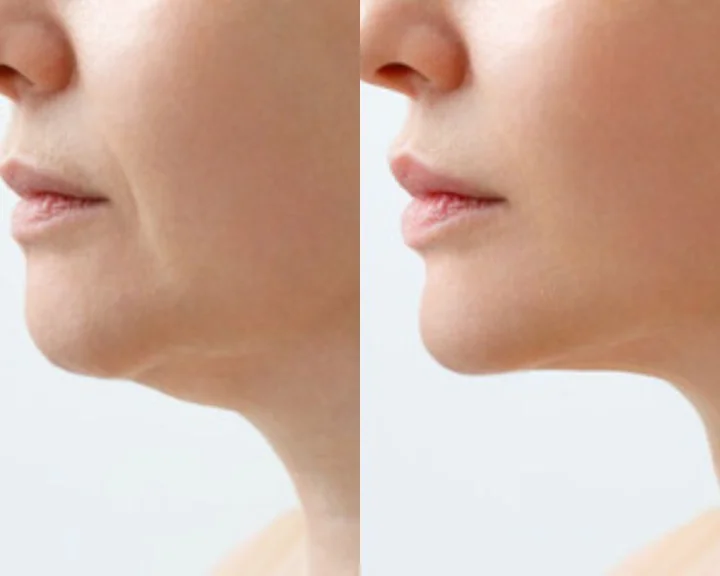 how to reduce double chin fat