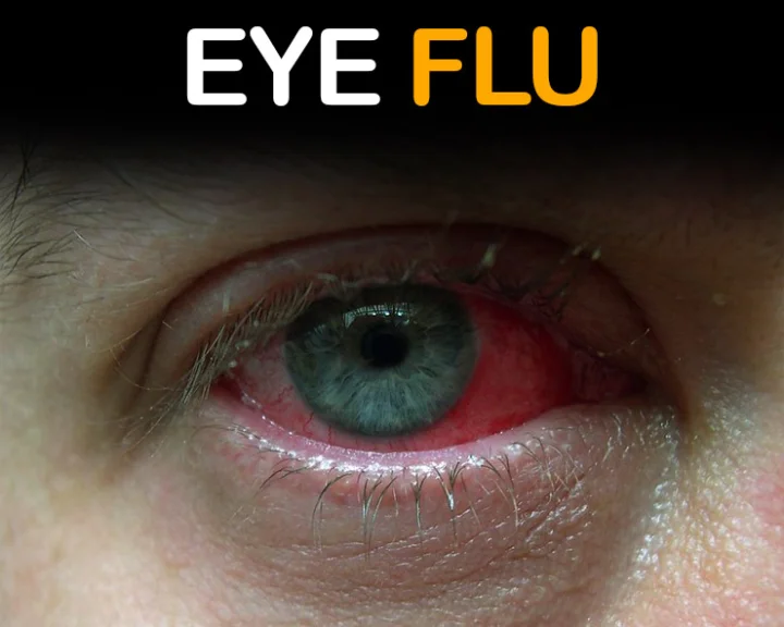 Eye flu