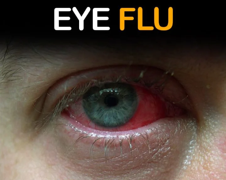 Conjunctivitis Prevention Tips