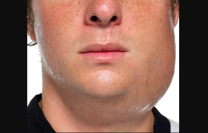 Mumps