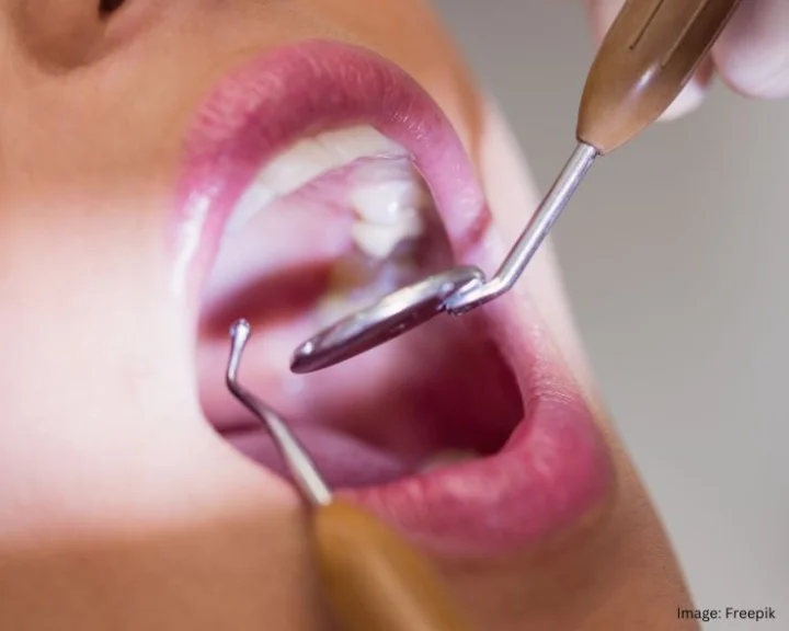 Wisdom Tooth Pain Relief Remedies