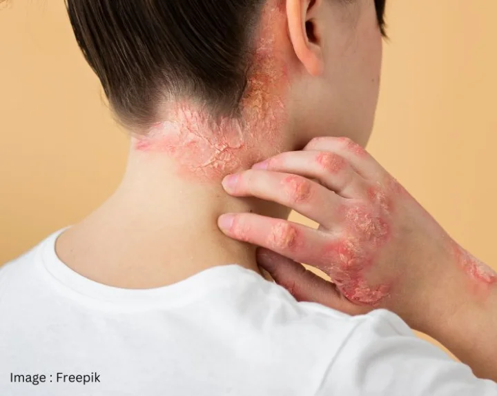 Monkey Pox Symptoms