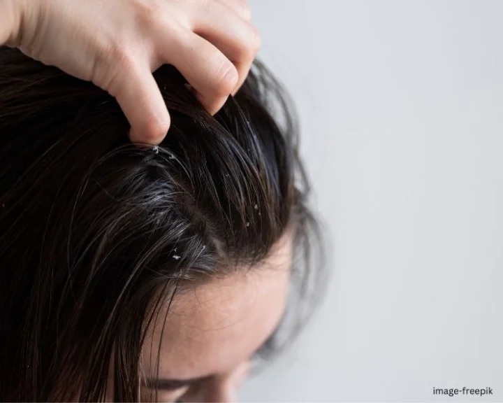 Scalp Infection Remedies