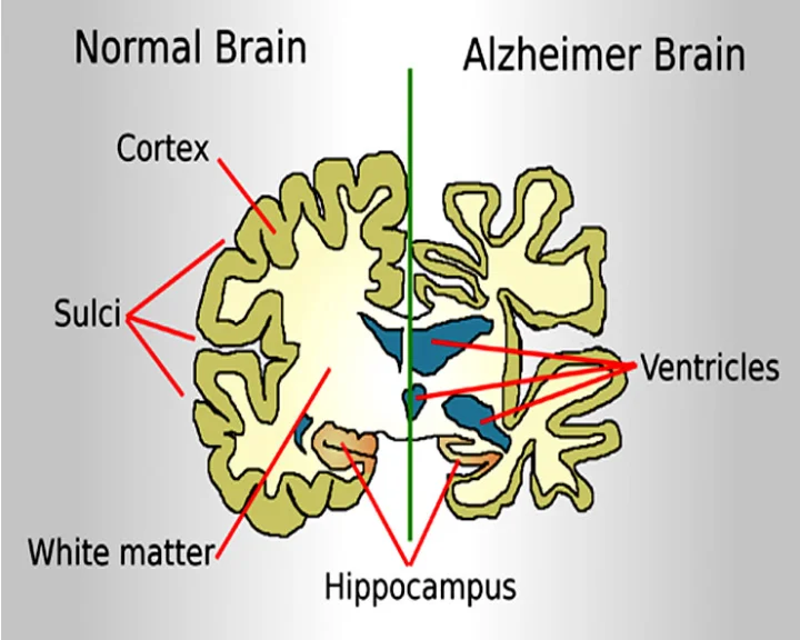 Alzheimer