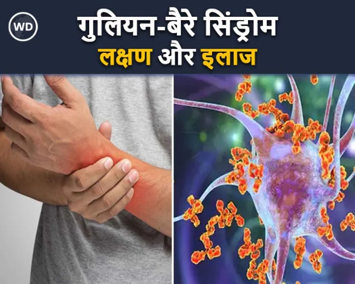 gbs outbreak pune